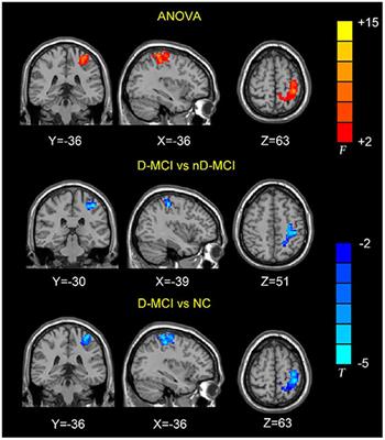 Abnormal Functional Connectivity of the Amygdala in Mild Cognitive Impairment Patients With Depression Symptoms Revealed by Resting-State fMRI